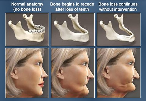 dental implants bone volume after tooth loss
