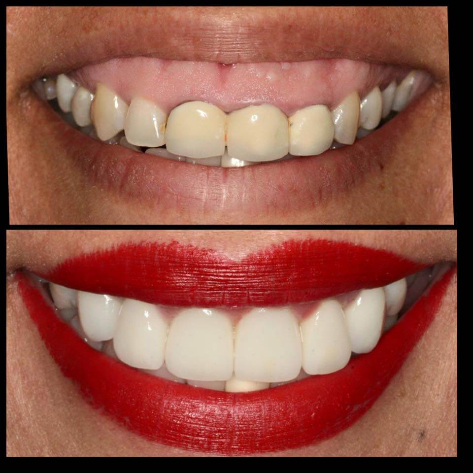 dental implant cost cosmetic dentistry