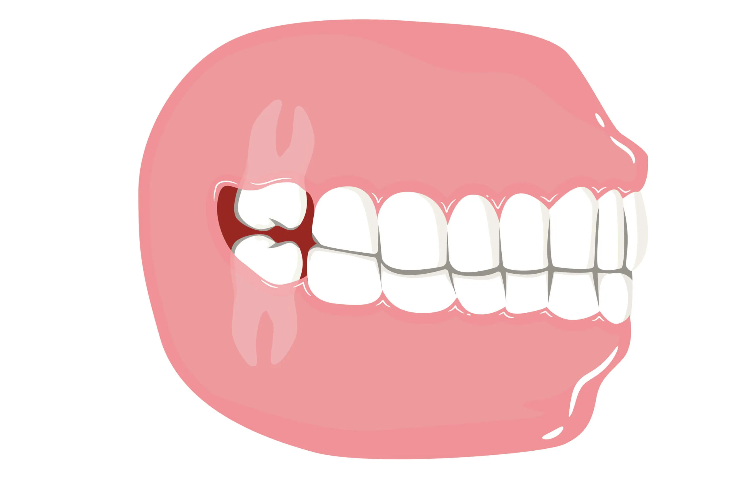 root canal treatment