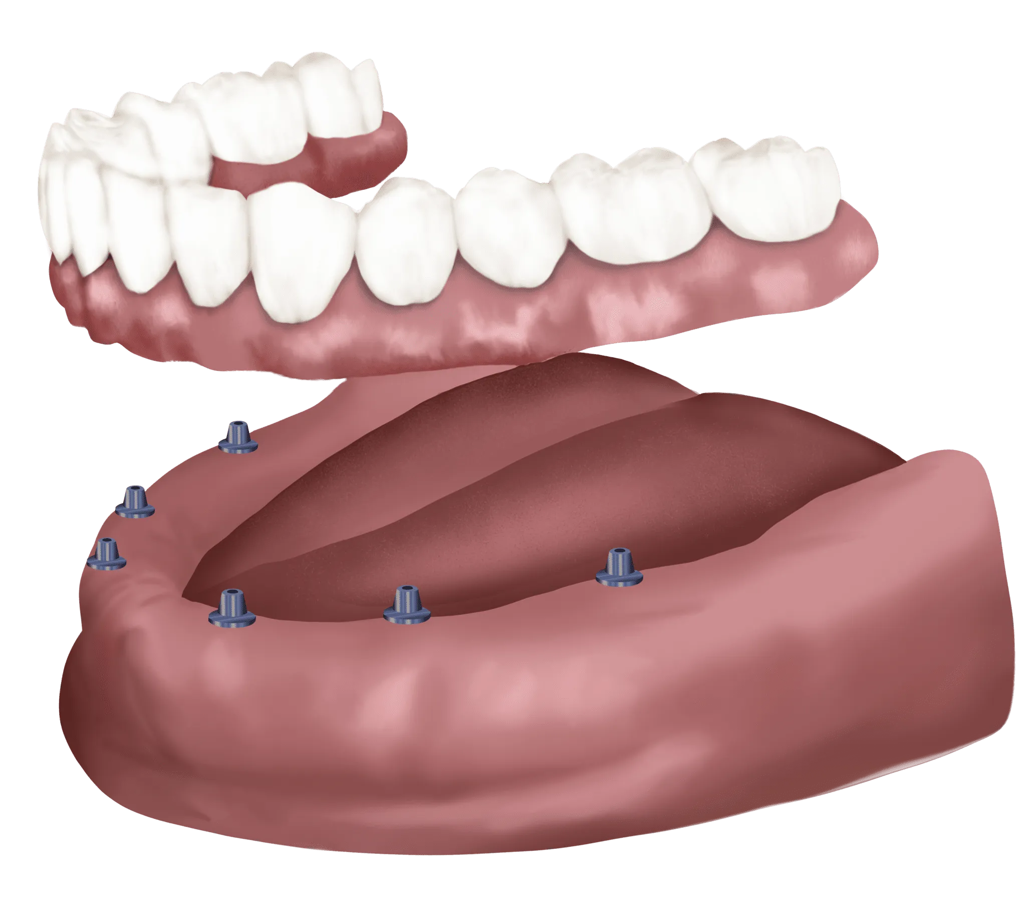 All-on-6 dental implants