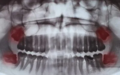 Wisdom Teeth Removal FAQs our dentists get asked by patients