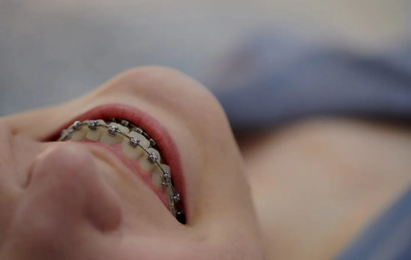 Aparatos de ortodoncia autoligables en Houston