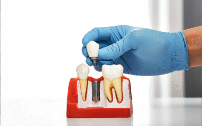 How Much Do Dental Implants Cost in Houston?