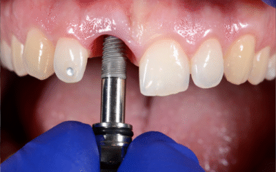 Dental Implants in Houston Heights