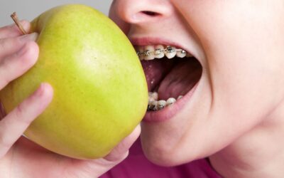 What Foods to Avoid with Braces: Houston Orthodontist Tips
