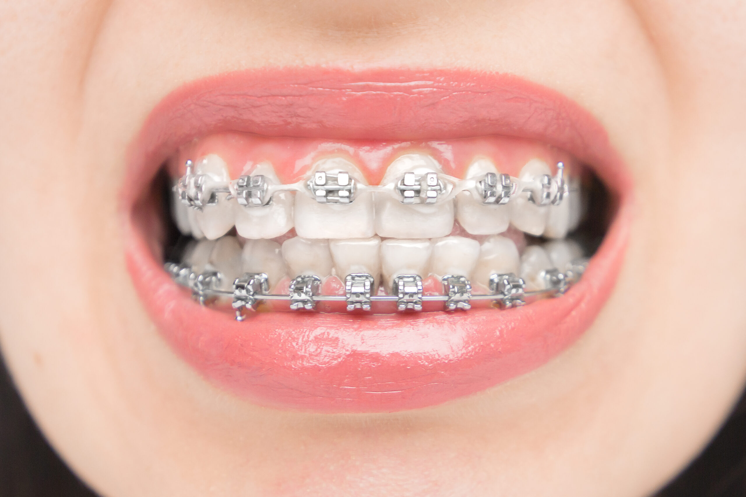 Expertos en Invisalign en Houston