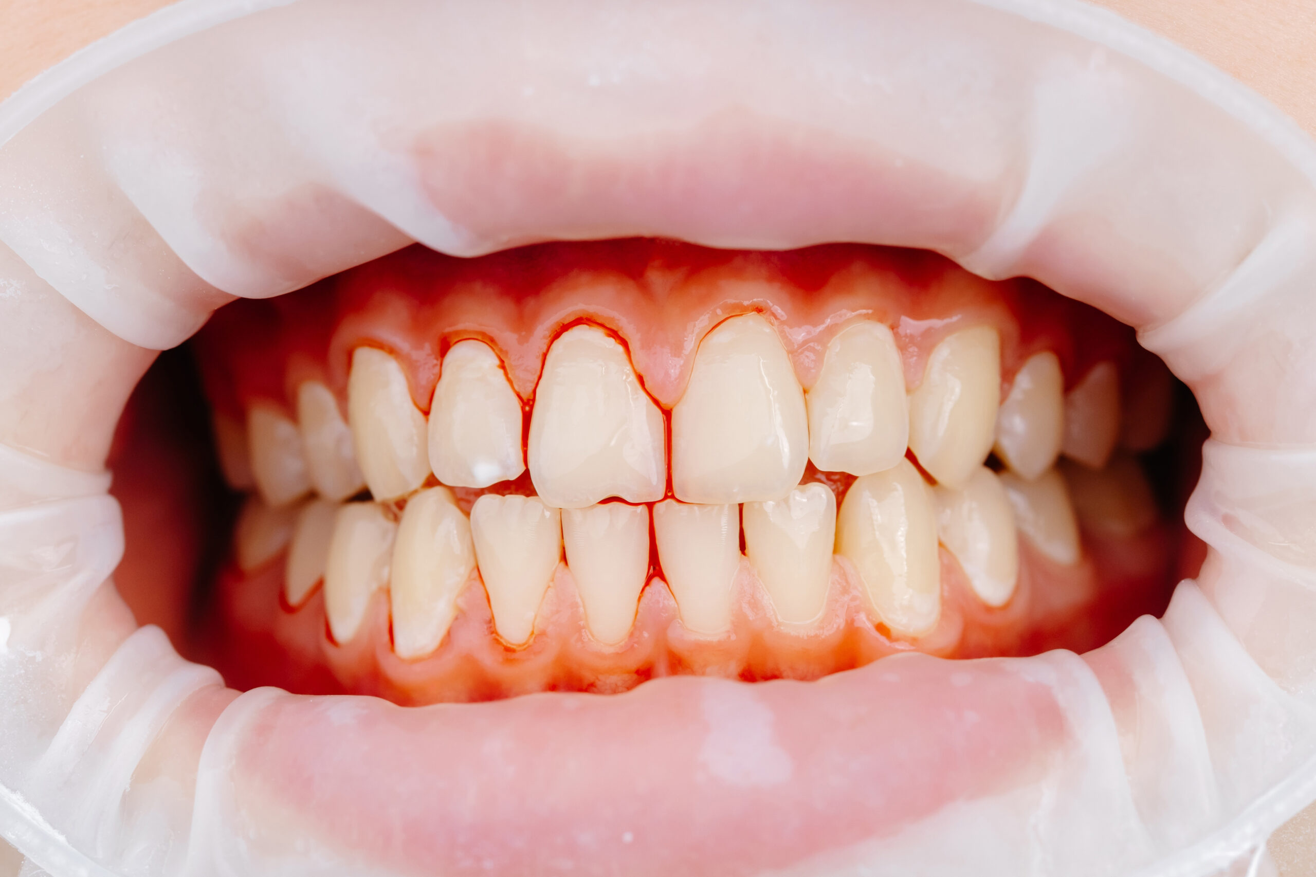 Invisalign experts in Houston