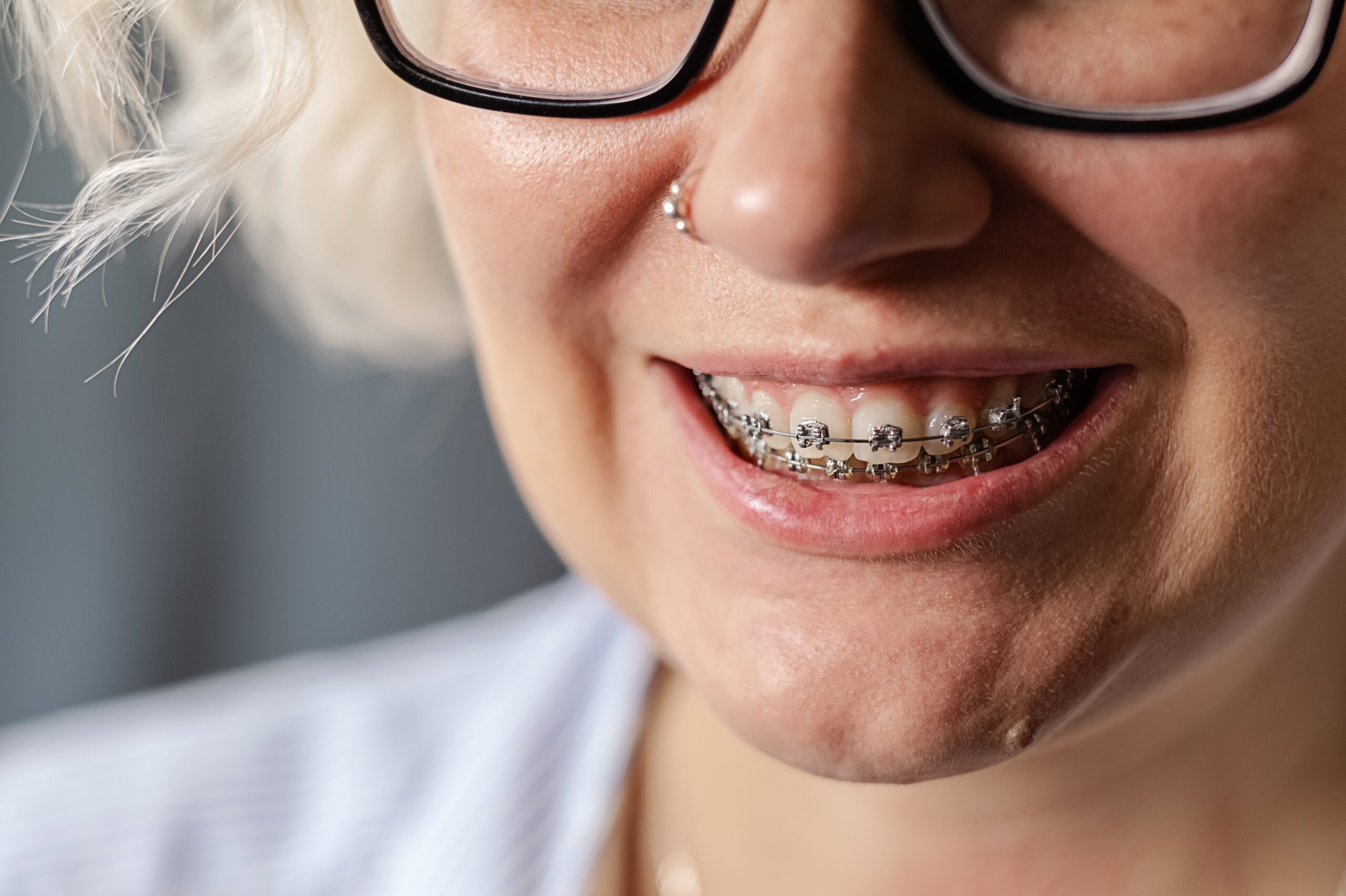 Invisalign experts in Houston
