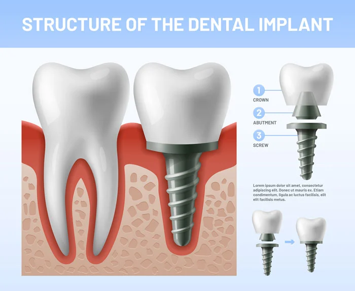 Dental Implants