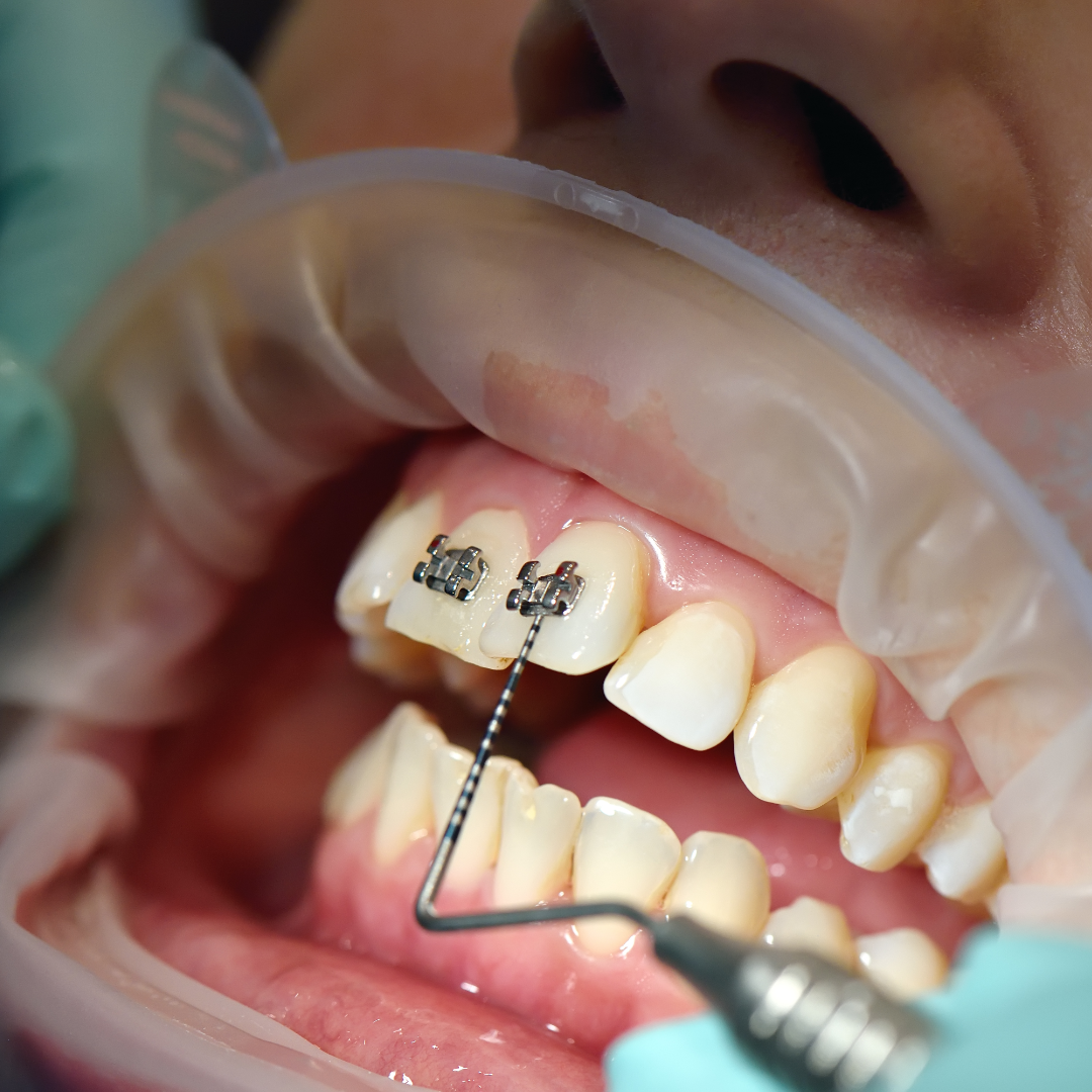 Homeowners have a great deal of options when it involves the materials for their privacy fences. Each has advantages and disadvantages, as well as there can be significant expense differences both as a result of the cost of the products themselves as well as the expense of labor to mount them. Every one of the alternatives will certainly supply privacy, with differing levels of safety unit for family pets and children. A few of these expenses are unavoidable, depending on where you live. If so, the price of eviction and hardware will add to the complete price. Consider the area of the building lines and also exactly how much inside them the local code needs a fencing to be mounted. A western red cedar fence can last up to 30 years with appropriate maintenance.