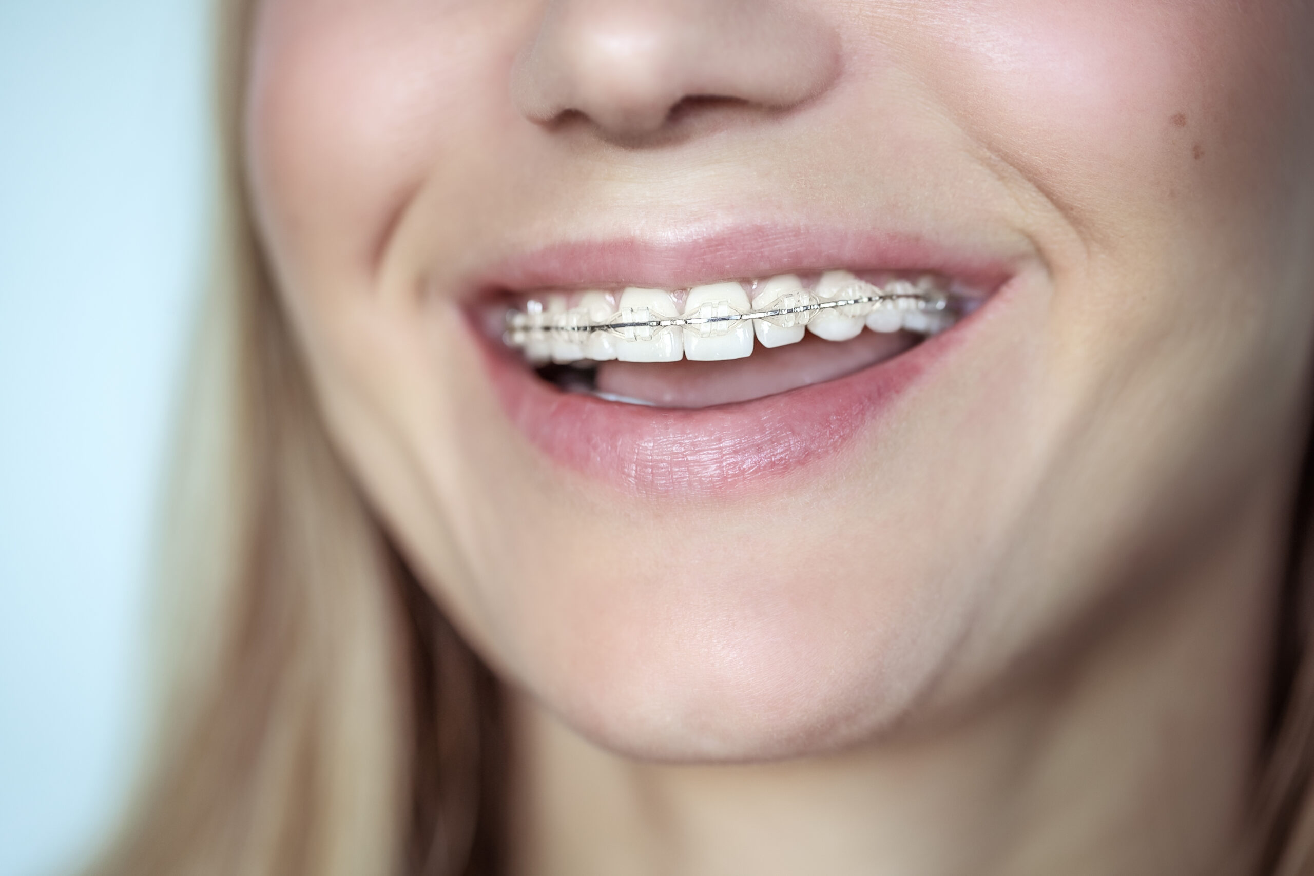 Invisalign experts in Houston