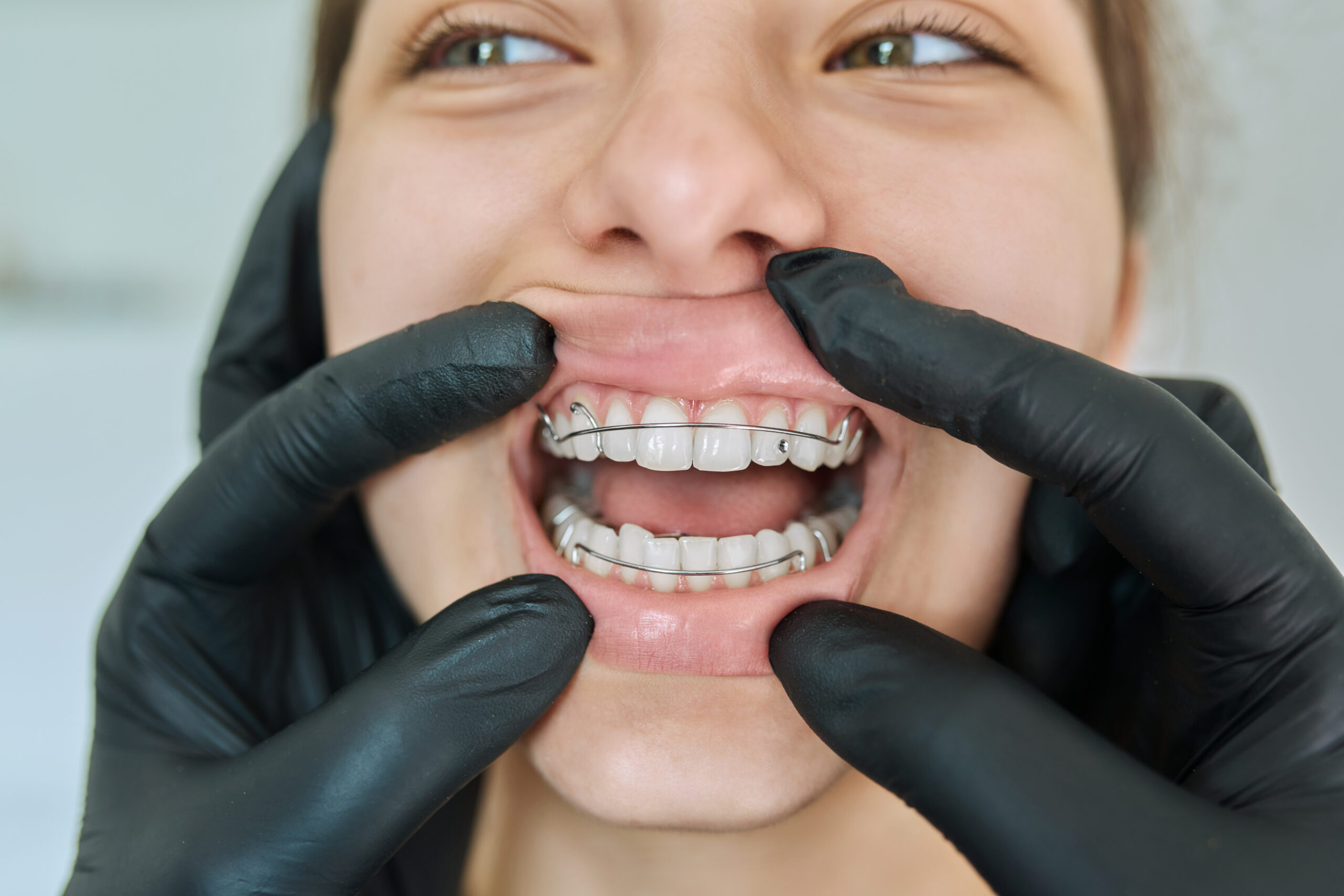 Invisalign experts in Houston