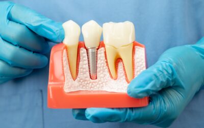 Single Dental Implants: Everything You Need to Know