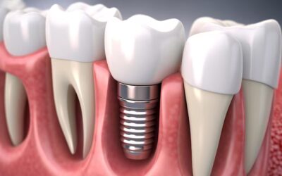 Get a Confident Smile with Modern Dental Implant Solutions in Houston