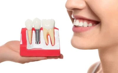 Same-Day Dental Implants in Houston – Are They Right for You?